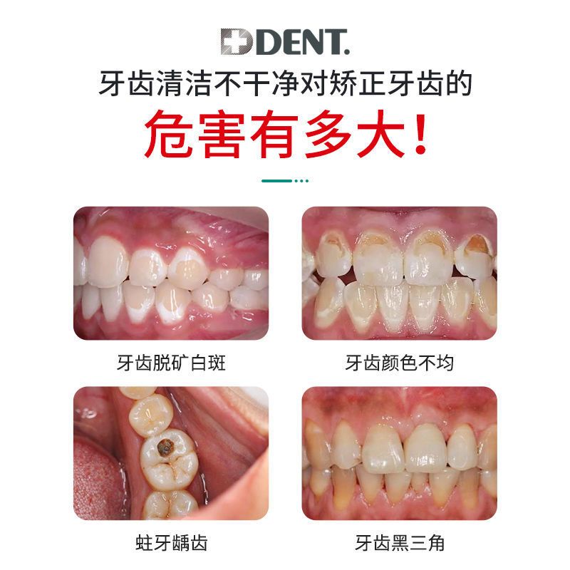 75g 日本狮王成人含氟护牙素防蛀牙正畸牙齿脱矿白斑修复牙釉质再矿化
