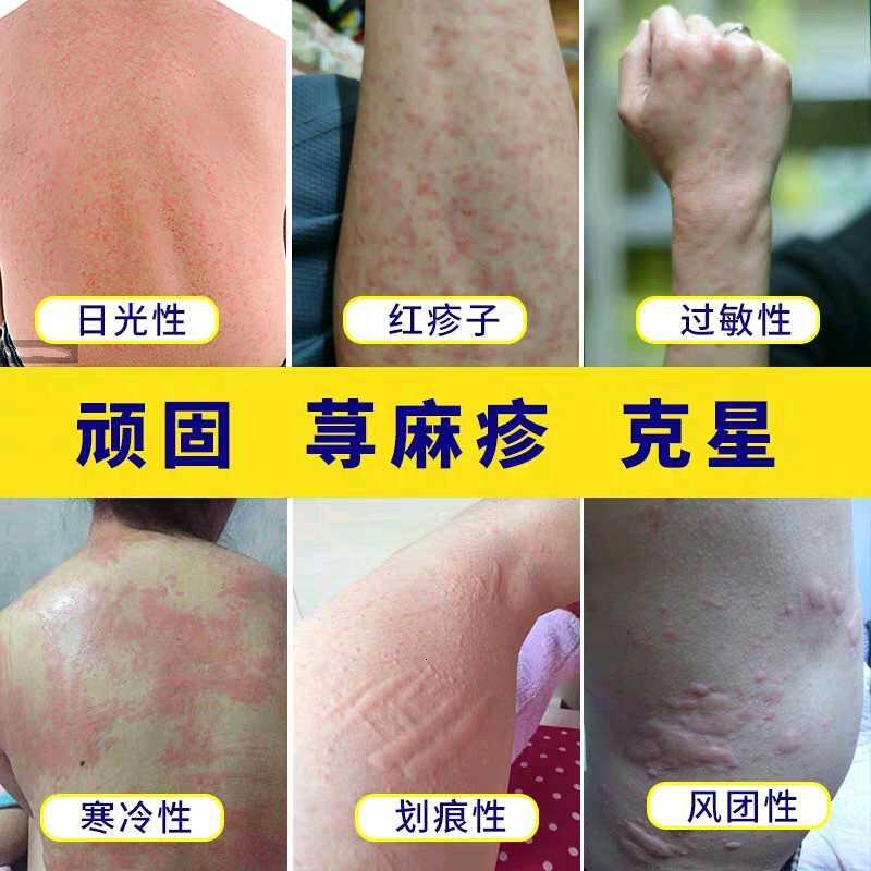 寻麻疹皮肤专用专用治急慢性寻荨麻疹外用去根风团过敏皮肤瘙痒止痒丸