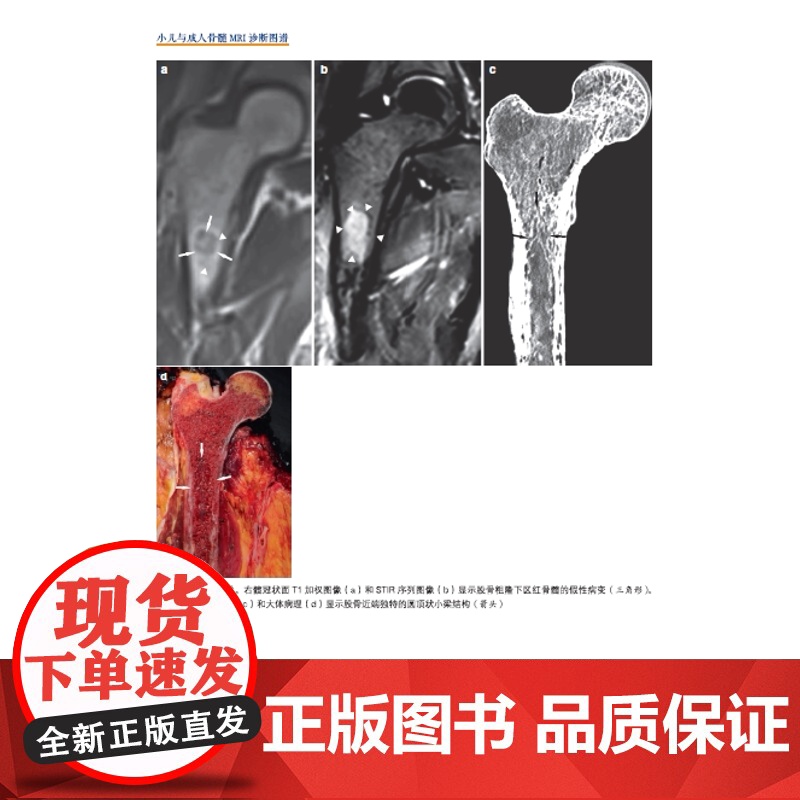 小儿与成人骨髓MRI诊断图谱 正常表现、变异和弥漫性病变 图文结合医学专著 广东科技出版社店发货高清大图