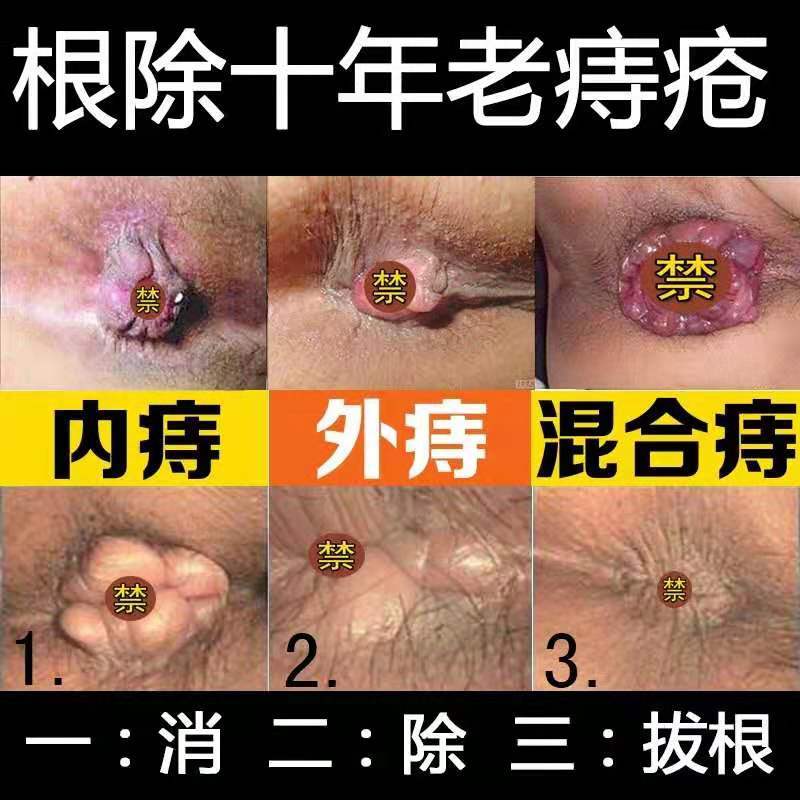 植柏诗 Zhibaishi 须泡 膏 啫喱德国脱肛的药肛周脓肿肛裂愈合膏痔疮药膏外用痔根断进口 价格图片品牌报价 苏宁易购兆裕美妆专营店