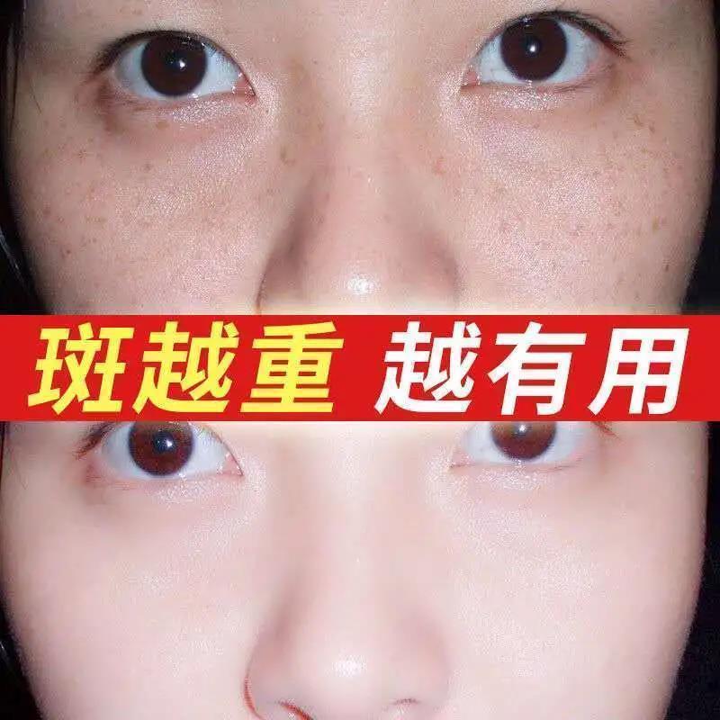 [美白祛斑]去痣神器白点痣笔激光祛斑笔无痕点斑脸部祛黑痣 1支[面部淡斑]祛斑笔新款