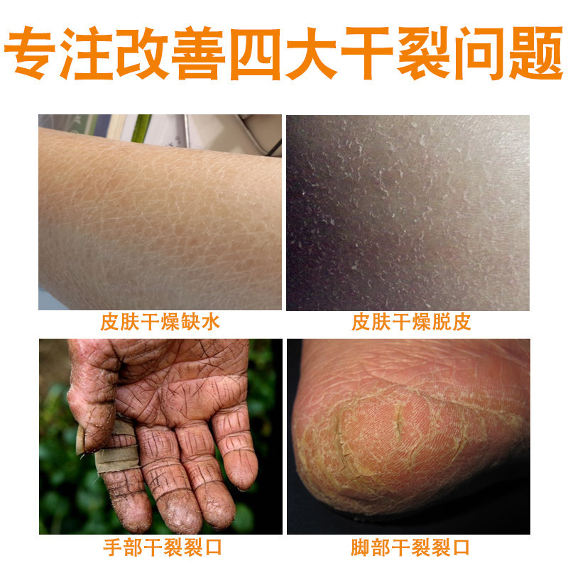 雷曼皲裂膏护肤乳膏 手足皲裂膏皲裂霜防皲裂手脚干裂粗糙手脚开裂手足护手霜润体霜25g
