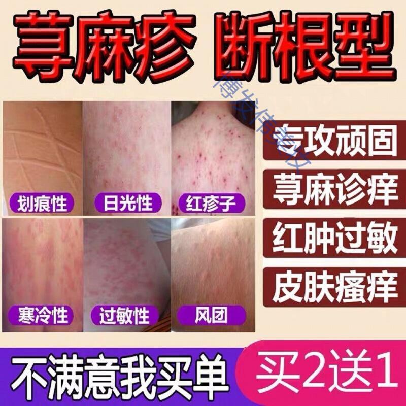 寻麻疹皮肤专用专用治慢性寻荨麻疹外用去根风团过敏皮肤瘙痒止痒中膏
