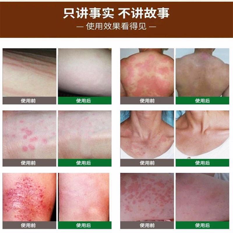 三珍清紫椒酊牛皮手足癣藓神经性皮炎外用湿疹止痒去根膏