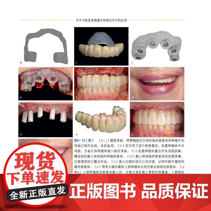 [出版社]水平与垂直骨增量在种植治疗中的应用 克雷格·米施 骨科学种植体植入钛网骨移植口腔牙体牙髓 辽宁科学技术出版社高清大图