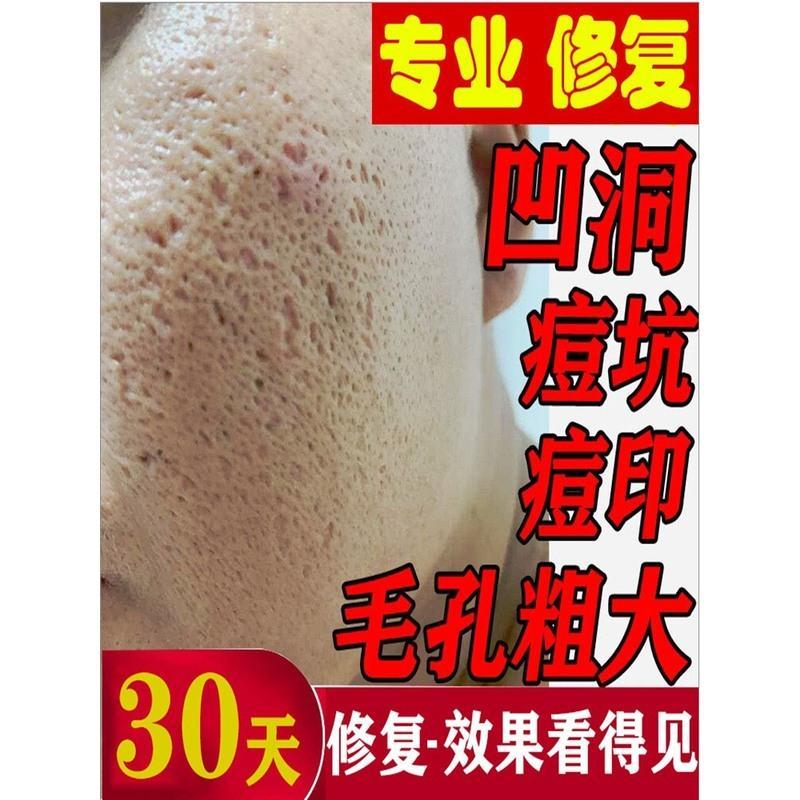 缩小毛孔粗大修复收缩毛孔女男士紧致祛凹洞去痘印痘坑痘疤神器男