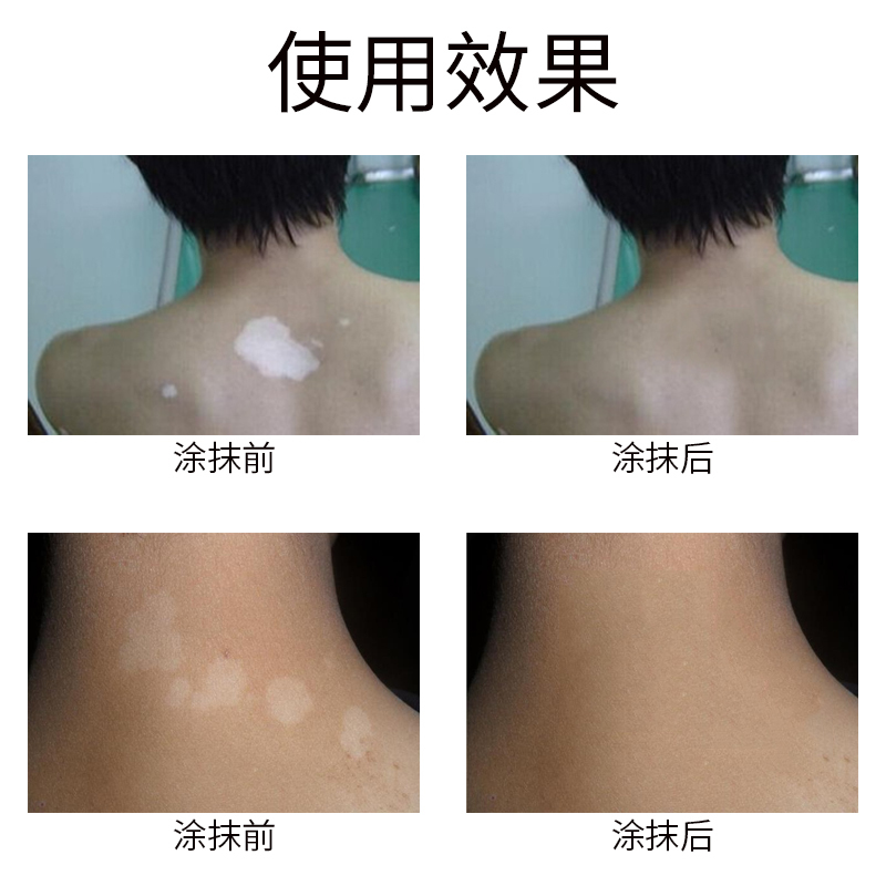 盛济堂 白斑遮盖液 修饰白斑肤色 白癫风遮盖液外用遮瑕防水持久型