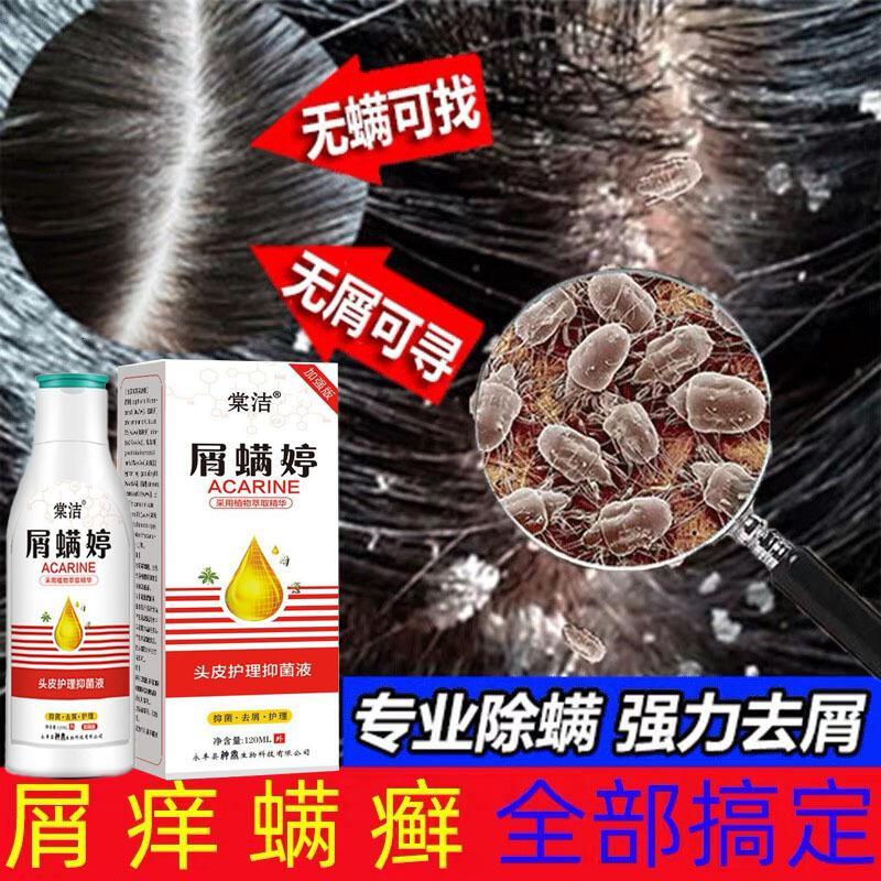 抖音同款溢脂性皮炎头皮毛囊炎洗发水脂溢性皮炎头皮外用康王洗发水头皮毛囊洗炎去疙瘩痘痘头皮洗发水露
