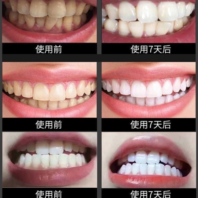 美牙仪议美牙白仪牙齿美白仪碧缇福牙齿美白神器去黄凝胶洁牙仪器 套装+凝胶(共2支凝胶)