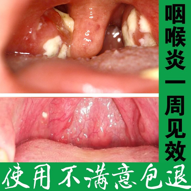 咽炎的喷雾畅瑞康咽喉炎慢性咽炎喷雾剂异物感特效喷剂