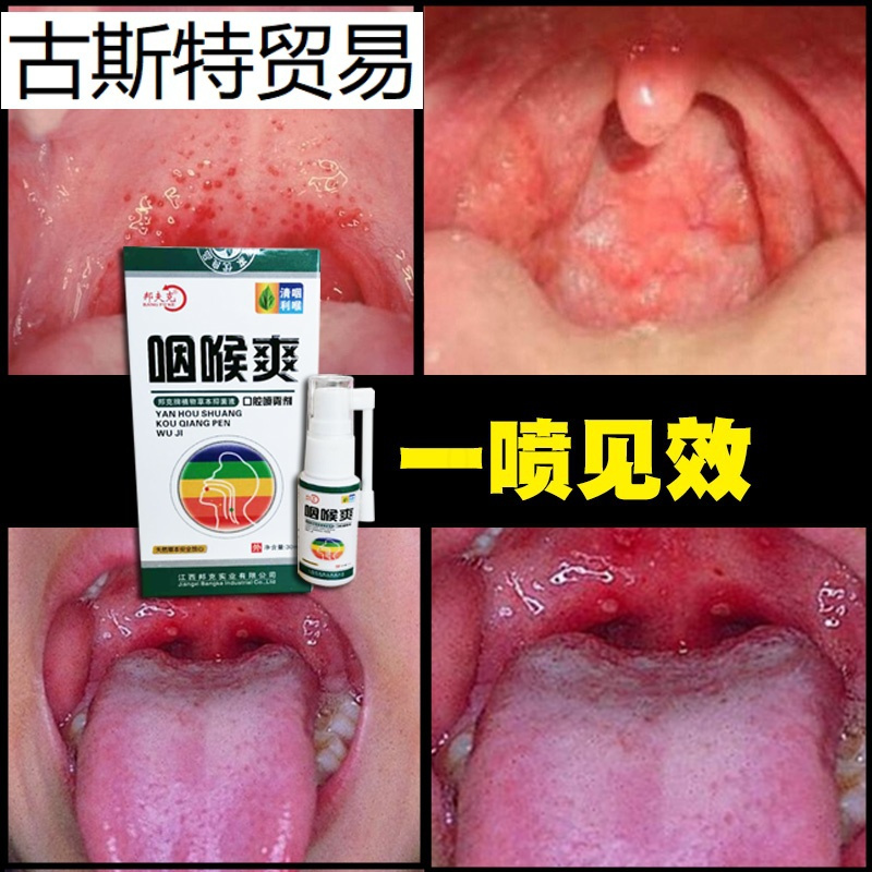 治咽喉炎疗慢性咽炎喷雾剂异物感滤泡增生除根化痰喷剂神器特效