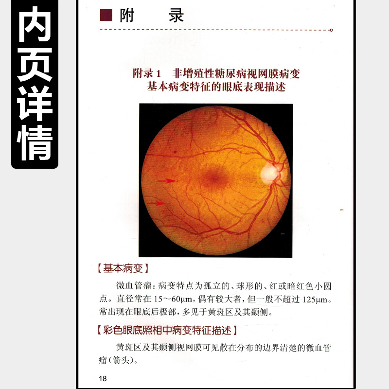 [正版] 中国糖尿病视网膜病变防治指南-基层版 全国防盲技术指导组编著 眼科学疾病临床案例诊治教程 人民卫生出版社978高清大图