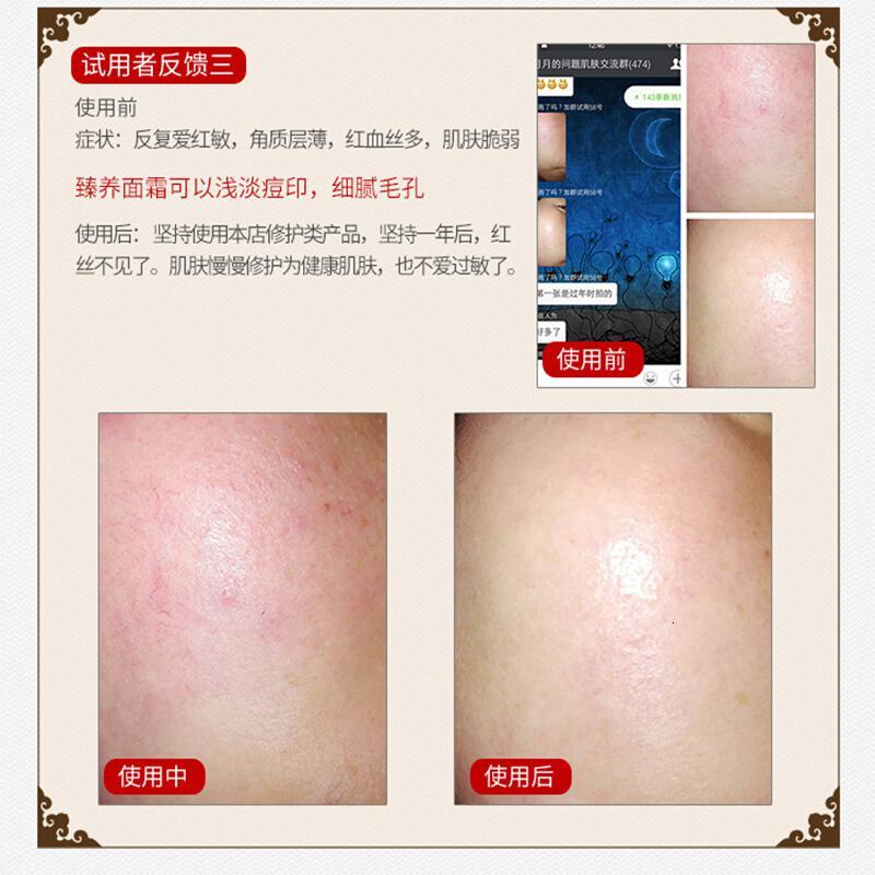 臻养面霜重整霜修护过敏去红血丝痘印痘坑肌肤专用护肤品