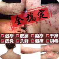 藏药湿毒王药膏苗药牛皮癣立克大腿内侧瘙痒股癣药膏汗斑藓白斑私处龟头炎外阴止痒肛门肛周湿疹皮炎鹅掌风手癣脱皮脚毛囊炎18克