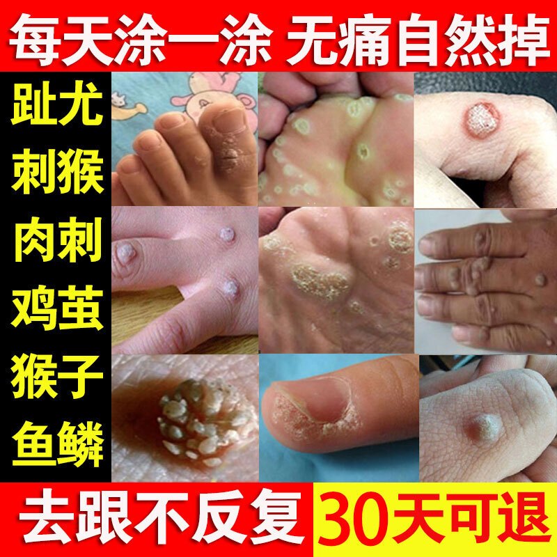 去猴子肉粒疙瘩刺猴去除猴子刺猴肉手部足部断膏根