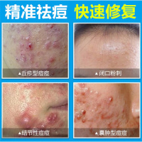 去痘洗面奶男士痘印痘疤去黑头螨虫祛除粉刺控油学生女祛痘坑