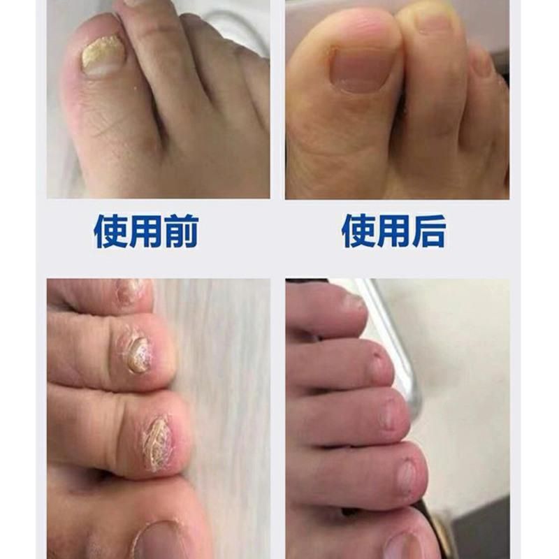 [官方认证]灰指甲特效增厚专用抑菌液灰甲亮甲去除坏甲脱甲 脱甲1盒[可脱3个指甲]
