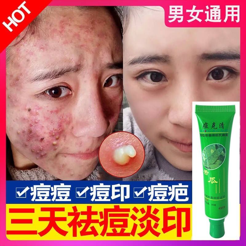 祛痘神器青春痘学生粉刺祛痘膏祛痘印痘坑修复草本无激素安全 祛痘膏1支[体验装不推荐]
