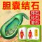 胆康贴[99%消结石]胆囊结石贴右上腹痛腹胀排石化石专用贴 胆康贴1盒装[少数人购买]
