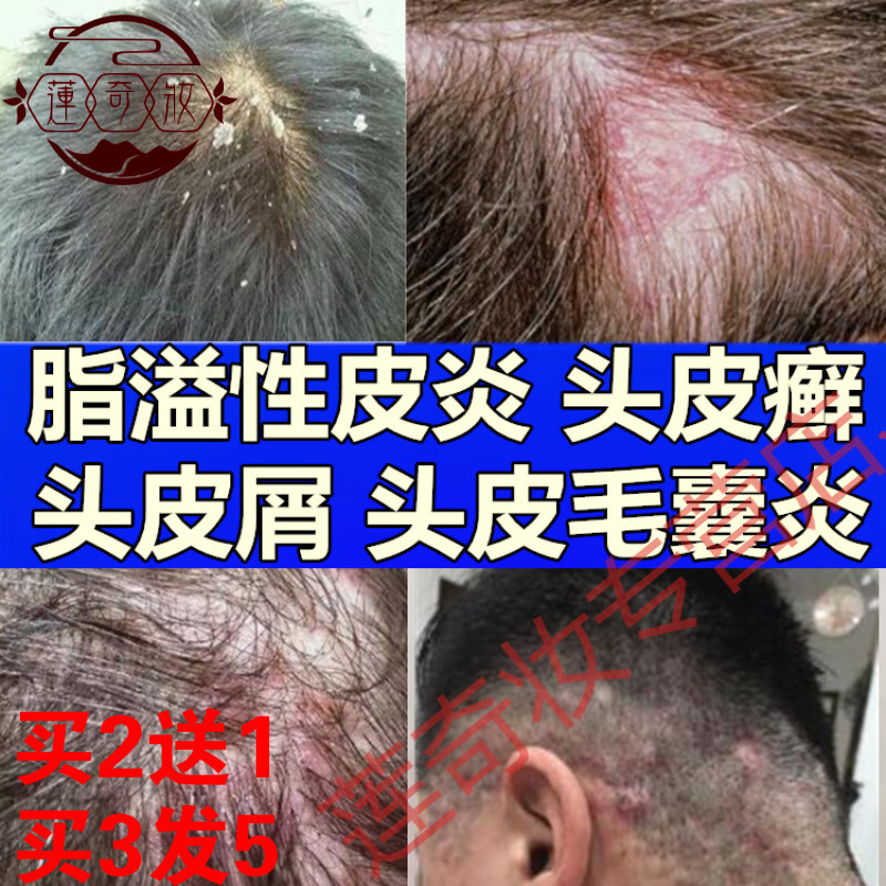 缤肌 Pinkypinky 洗发水诗莱格正品毛囊炎洗发水头皮毛囊炎头癣脂溢性皮炎头皮屑除去头螨去屑止痒洗发水 价格图片品牌报价 苏宁易购烁亨美妆专营店