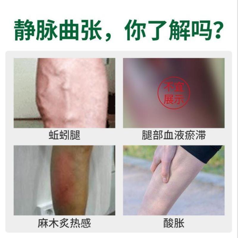 云南本草静脉曲张膏男女性腿部脉乐舒冷敷凝胶专用精索 轻度患者试用装[一瓶装]