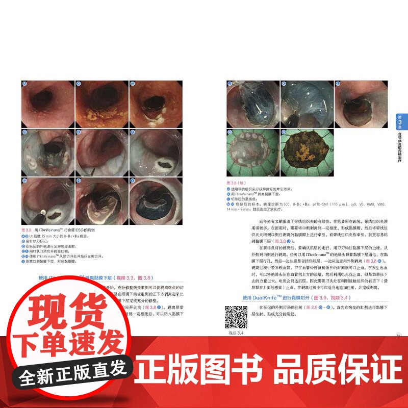 食管胃十二指肠ESD 操作诊断和治疗基础与技巧 ESD 内镜黏膜下剥离术 消化内镜 北京科学技术高清大图