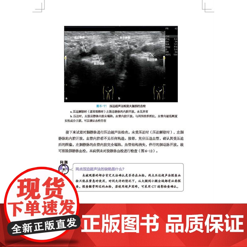 床旁即时超声 全书共10章 介绍了床旁超声在气道管理 呼吸系统 循环系统 中枢神经系统 下肢静脉血栓 腹部 运动系统 血高清大图