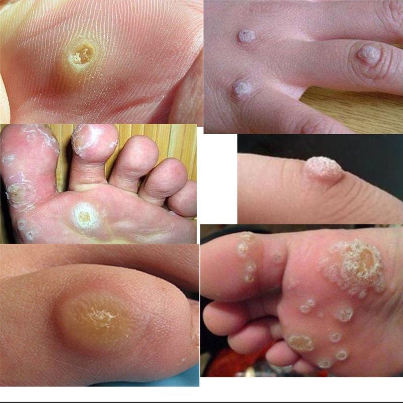 去鸡眼膏去除鸡眼贴跖疣膏除鱼鳞痣肉刺刺猴老茧足部瘊子
