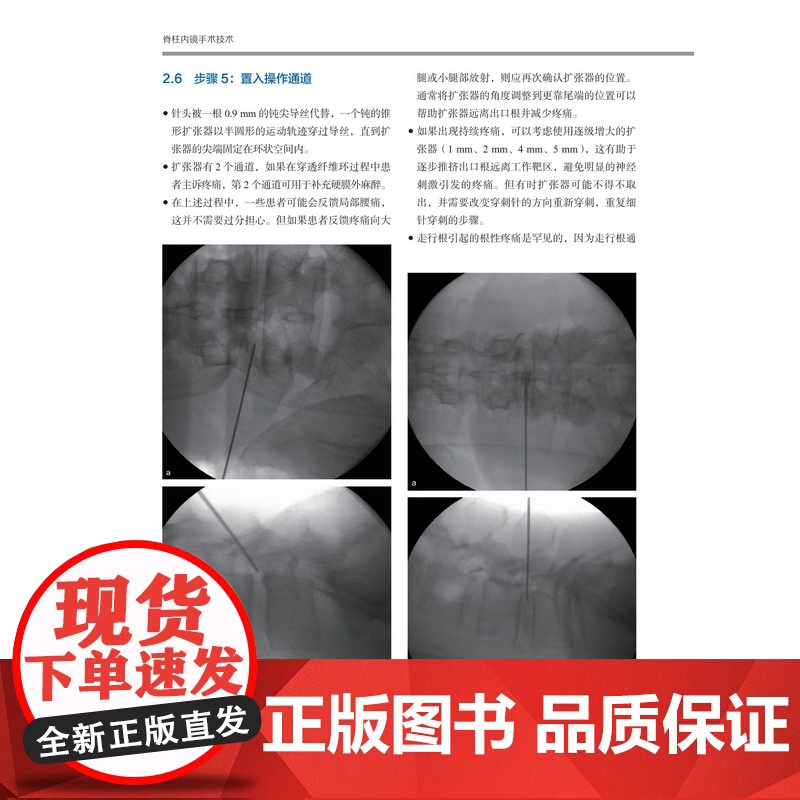 脊柱内镜手术技术 视频配合学习 外科手术图解 临床应用 手术技巧分析 病例分析 北京科学技术高清大图