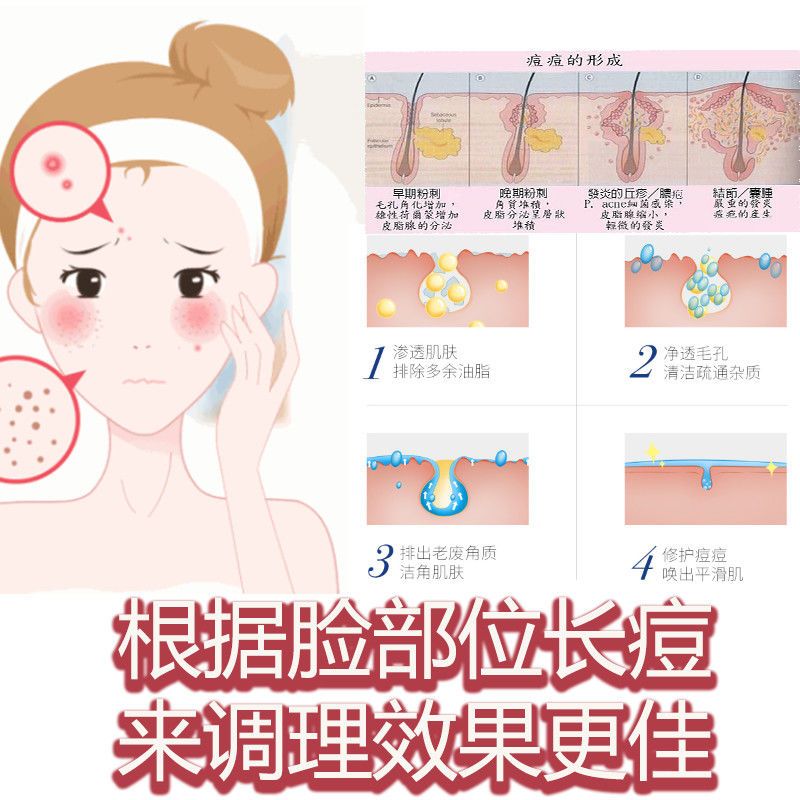 楽藤祛痘膏草本男女青春痘学生粉刺乐敦去印霜淡化祛痘膏祛印膏 单支祛痘