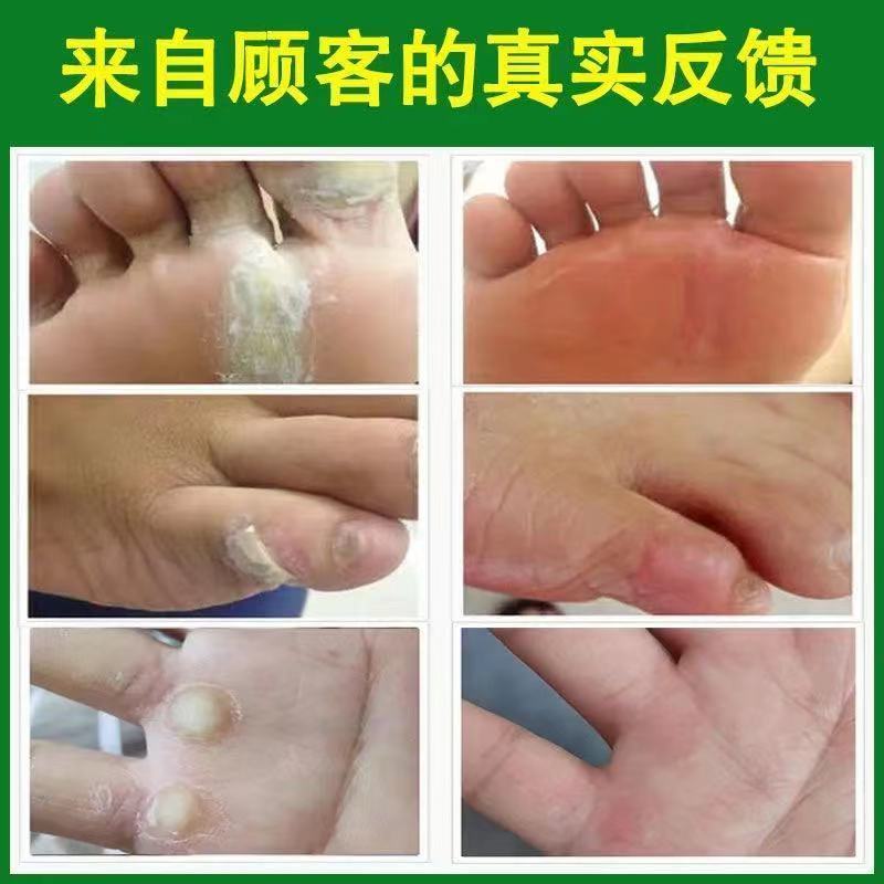 一盒装 去脚底死皮老茧脚后跟软化剂老茧去除脚茧厚茧硬皮脚趾头老茧神器
