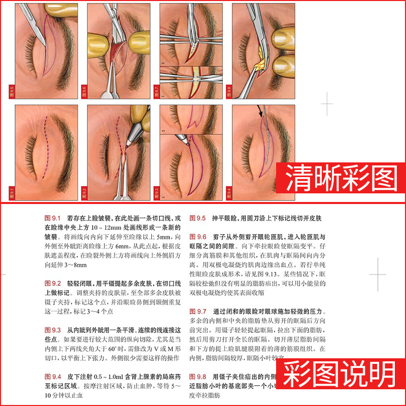 [正版]眼整形眼眶手术图谱 第2二版 李冬梅主译 曹思佳秘籍全套东厂秘训面部眼部眼科美容外科学书籍微整形注射医学医疗咨高清大图