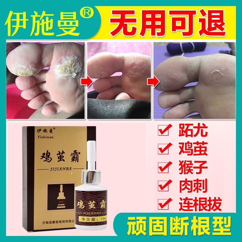 专用鸡眼膏特效手脚趾底足上鸡眼贴去除跖疣死皮猴子老茧肉刺瘊子