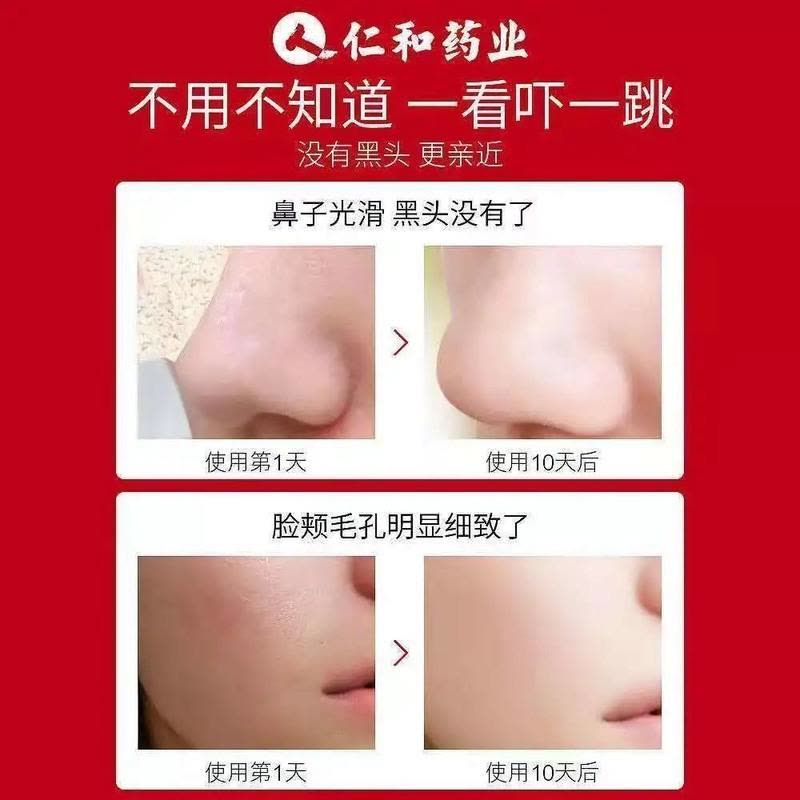 仁和去黑头套装 仁和去黑头套装收缩毛孔清洁修护祛黑头神器鼻贴吸黑头粉刺导出液图片