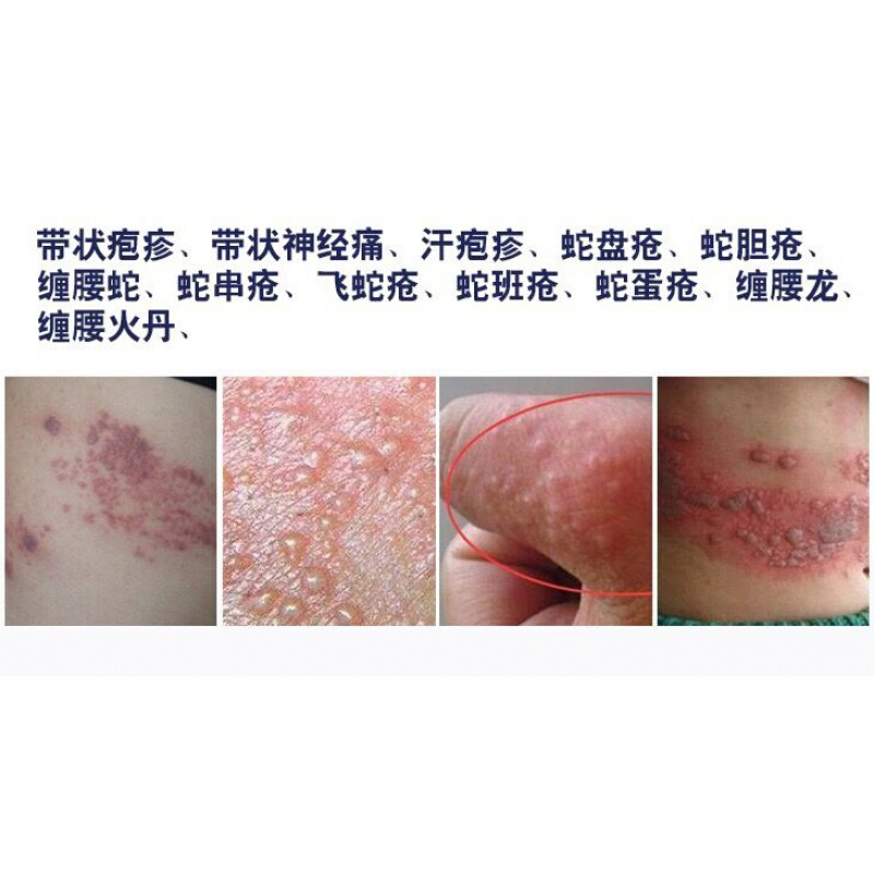 贝踏益泓堂伏蛇宁官方带状泡疹蛇胆疮贝踏益泓堂