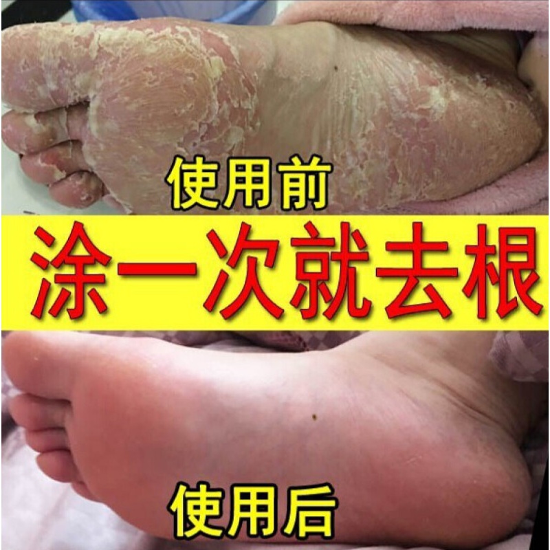 Q膏要烂脚丫脱皮糜烂水泡型止痒去除呿真菌感染脚痒喷剂膏要图片 高清实拍大图 苏宁易购