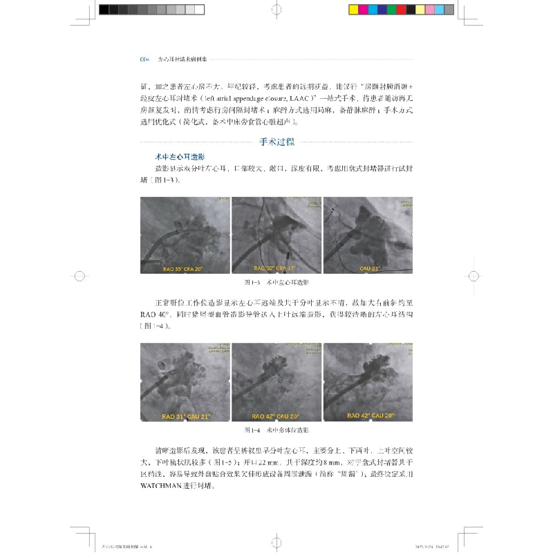 醉染图书左心耳封堵术病例集9787547858998高清大图
