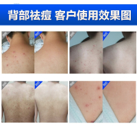 满婷(Manting)除螨后背部祛痘痘沐浴露螨婷男女去螨虫鸡皮肤疙瘩净螨家庭装