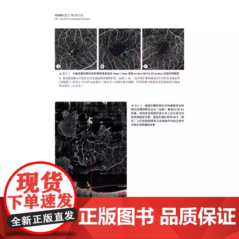 [央视网]眼底病OCT与OCTA 以言简意赅的表达形式对不同眼底疾病的影像特征进行细致描述 并配有丰富的图片资料ZK高清大图