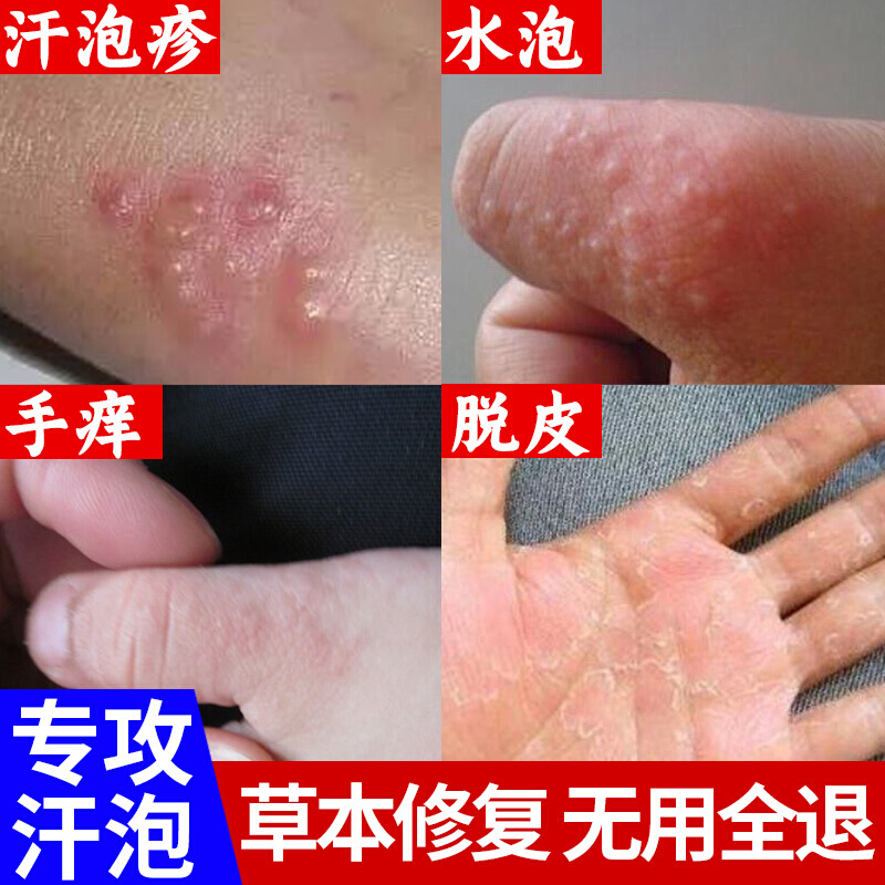 玉裂康玉裂乳膏康手气非止痒手上起小水泡干裂手痒膏脱皮季节性水泡型