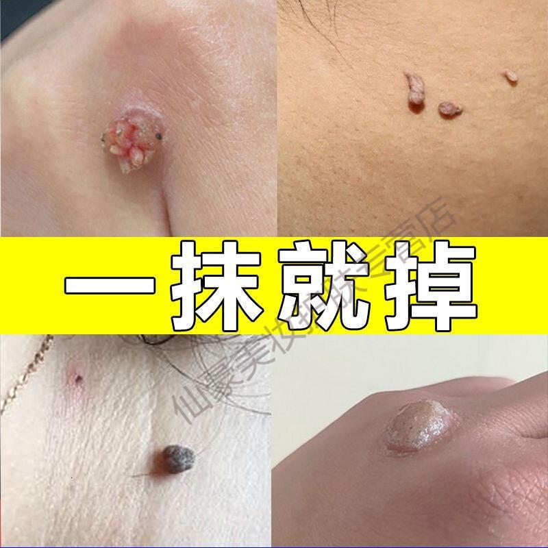 去除脖子小肉粒颈部赘皮赘温和不留疤祛丝状尤腋下小猴子