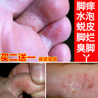 澳福来AO FU LAI脚爽喷剂85ml 去香港脚臭脚气脚底脱皮痒水泡糜烂脚丫脚汗脚裂护足霜