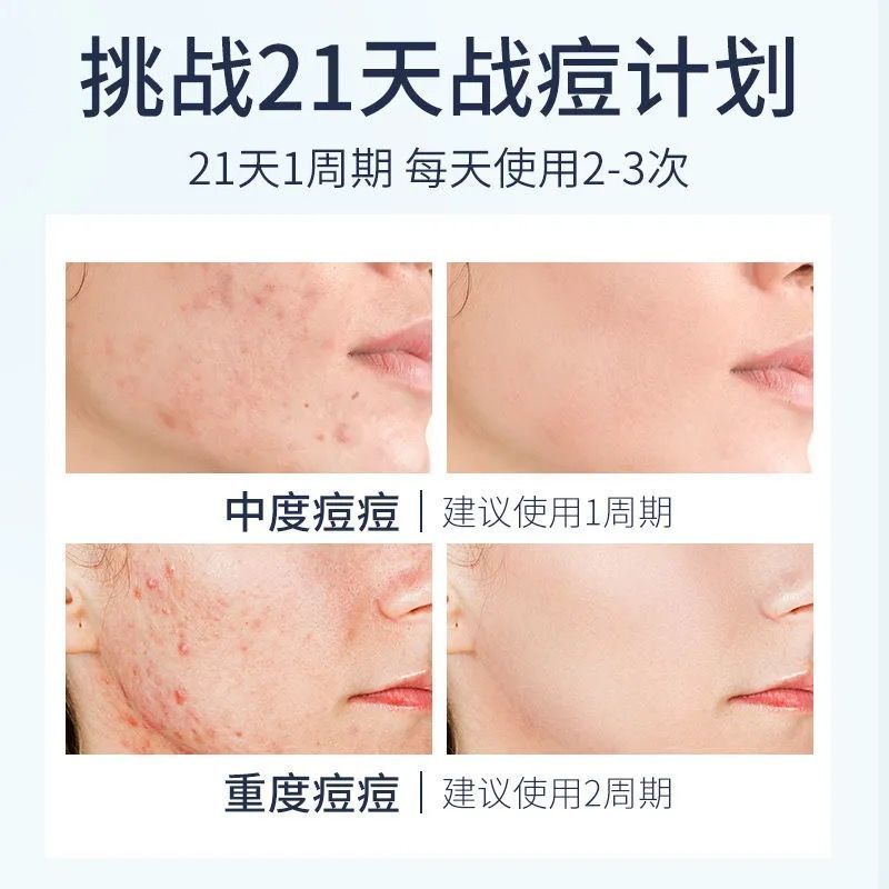 &lt;李佳琦推荐&gt;祛痘膏去痘印粉刺痘印修复男女学生祛痘疤痘坑去痘膏 一瓶装[轻度试用]