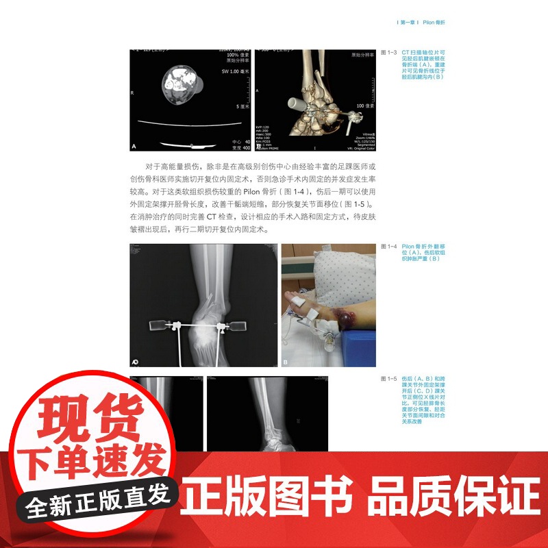 积水潭医院创伤骨科手术技术 足踝骨折 北京积水潭医院手术经验全景展示 北京科学技术高清大图