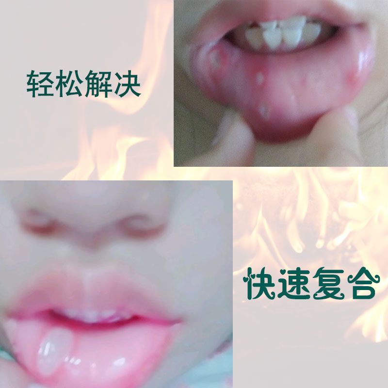 清火去口腔上火溃苔痛藓疡除口臭烂白嘴点角舌头疮起泡非药漱口水