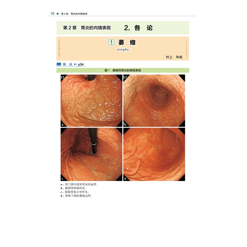 [正版]京都胃炎分类 慢性胃炎胃癌风险内镜诊断与分类表现 胃炎分类辅助诊断治疗 胃炎临床治疗 胃炎内镜诊断治疗技术