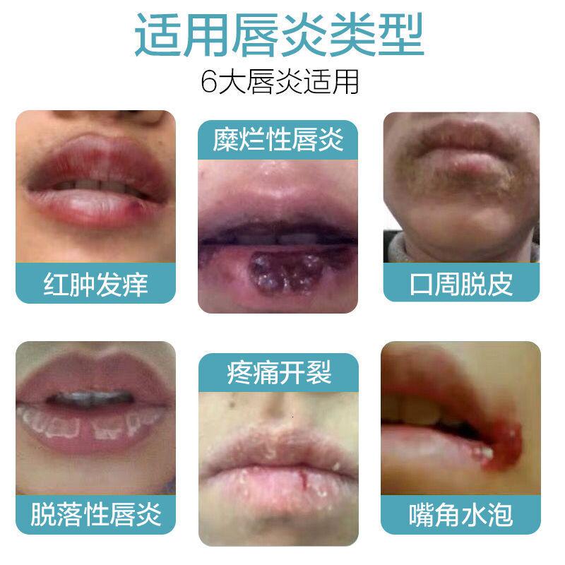 蓝尼芳可 Lnfk 唇膜嘴唇唇炎唇膏有效修复嘴唇嘴唇唇炎唇膏有效修复嘴唇干裂嘴角起泡脱皮慢性唇炎药效专用药 价格图片品牌报价 苏宁易购大白熊彩妆专营店