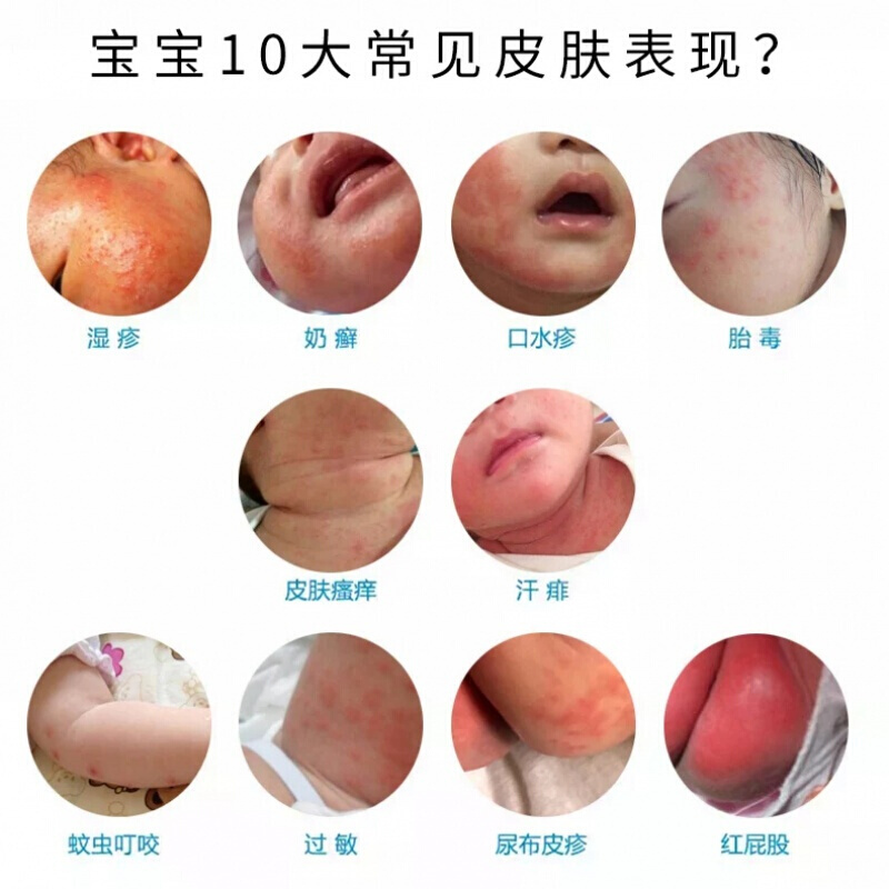 儿童宝宝奶藓婴儿款紫花地丁红屁股皮肤瘙痒蚊虫叮咬透