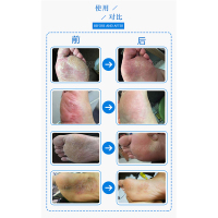 LAMISIL澳洲脚气膏(新版)足部护理 去除脚气脚臭脚痒脱皮 护足霜足膏 脚气膏15g/1支*2 澳洲进口