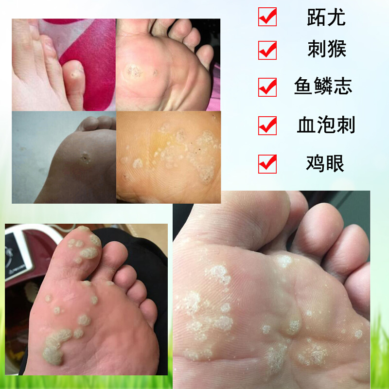 效妆洁面膏 霜去除脚底跖疣膏特傚治病毒拓疣砣袪手足部寻常疣趾疣瘊子灵刺猴子瘦腿霜 价格图片品牌报价 苏宁易购裕宏展化妆品专营店